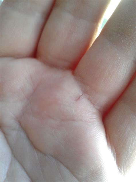 cortisone shot in hand still painful (back pain, hair, specialist