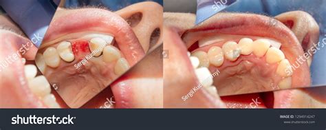 57 Tooth Extraction Before After Images, Stock Photos & Vectors ...