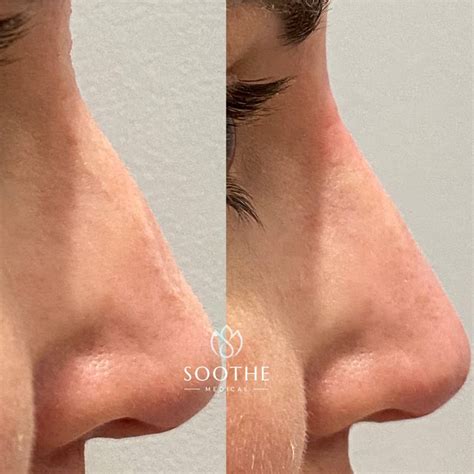 Dermal Fillers (Revance and Versa) – Soothe Medical
