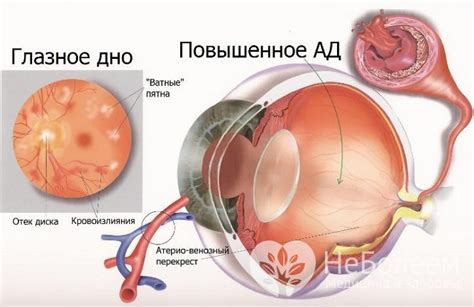 Ангиопатия нижних конечностей, гипертоническая ангиопатия сосудов