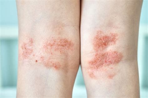 Effective Eczema Treatment in Gurugram, Haryana - Derma Vibes Offers ...