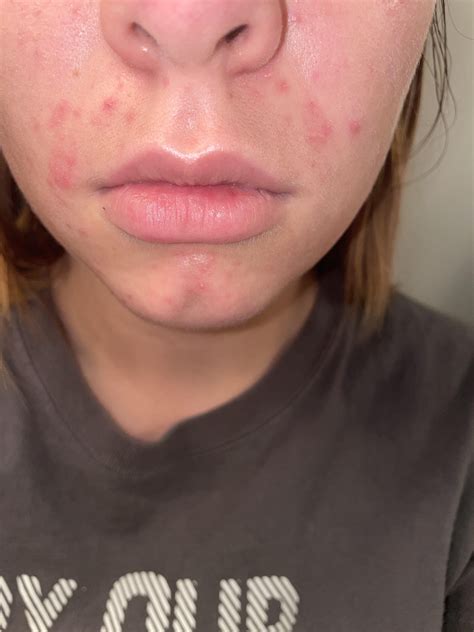 stubborn red spots on the bottom half of my face only, any idea what