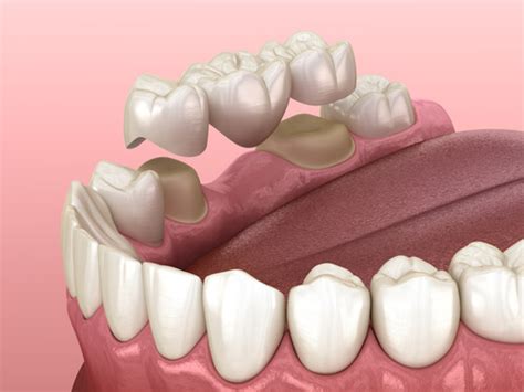 Pontic Tooth: A Dental Solution for Missing Teeth - Universal Society ...