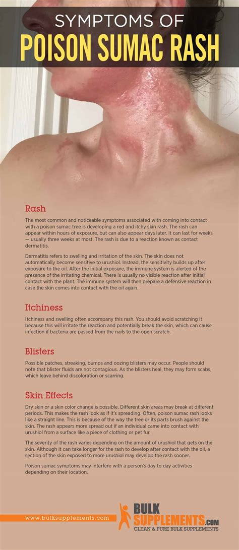 Poison Sumac Skin Reaction at Peggy Rios blog