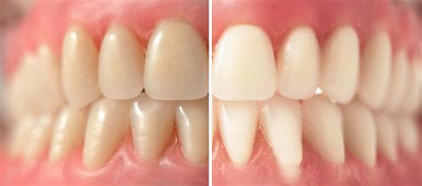 Say Goodbye To Stains: How To Whiten Dentures Effectively | Dr. Alex ...