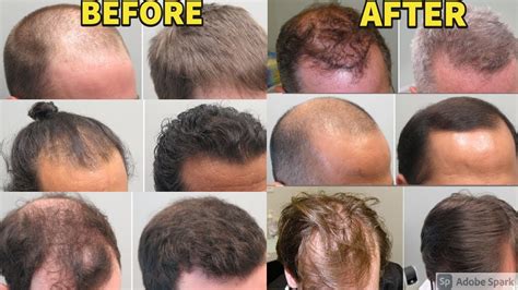 Souirensu It Works: See the Amazing Before & After Results - bv4o6nh