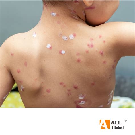 Hangzhou - #Molluscum contagiosum, commonly known as water warts, is a