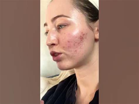 Губы опухли - YouTube