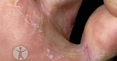 tinea pedis image