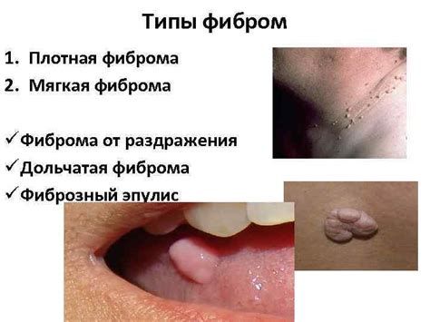Истинная Фиброма Фибросаркома Студент Рахмонов Х А