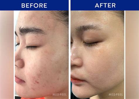chemical skin peel before and after– Medpeel
