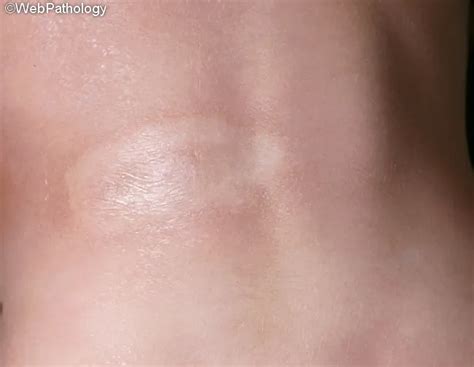 Localized Scleroderma : Morphea