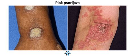 Psorijaza - Simptomi i uzroci - Bio Plar Blog