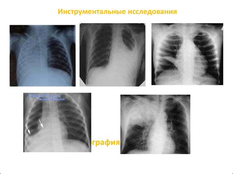Муковисцидоз - презентация онлайн