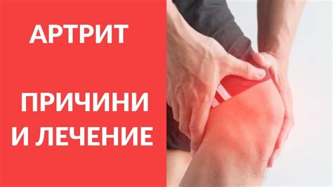 АРТРИТ - ПРИЧИНИ И ЛЕЧЕНИЕ - YouTube