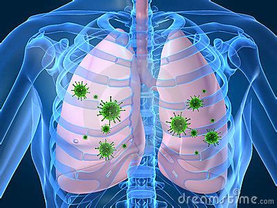 O Que É Infecção Respiratória - INFECÇÃO PULMONAR - O que é, como identificar e como é o seu tratamento ...