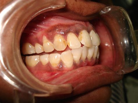 b. Gingival margin 1 month post operation. | Download Scientific Diagram