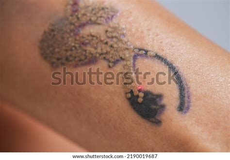 1,160 Tattoo Removal Artist Images, Stock Photos & Vectors | Shutterstock