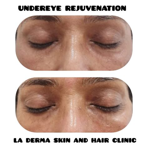 dark circles treatment  kolkata  latest prices la derma