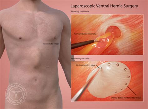 Cpt Ventral Hernia Repair 2024 - Benny Kaitlin