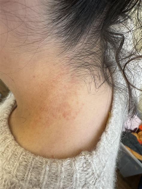 Sudden rash : r/DermatologyQuestions