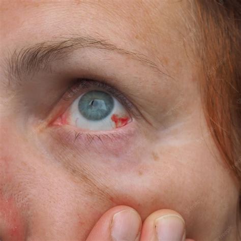 Premium Photo | Subconjunctival hemorrhage or subconjunctival bleeding hyposhagmus Bleeding ...