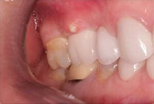 Tooth Abscess: Causes, Symptoms and Treatment | UtoDent.com