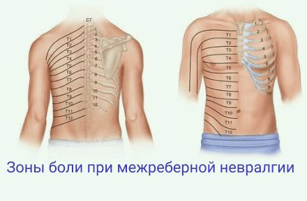 Лечение межреберной невралгии: симптомы, осложнения, диагностика ...