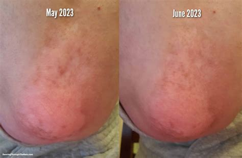 24 Weeks On Opzelura - A Vitiligo Treatment Update (With Pictures ...