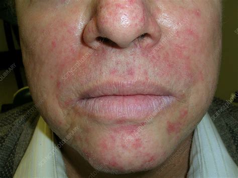 dermatitis stock image  science photo library