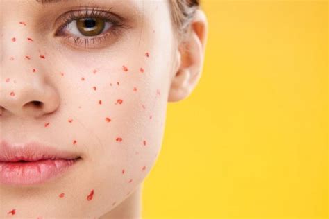 Ветрянка у взрослых: лекарства, используемые для ее лечения | MedAboutMe