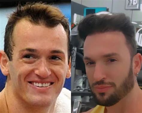 Diego Hypolito Antes E Depois Da Harmonização - Confira o antes e depois de Diego Hypolito: atleta passou por ...