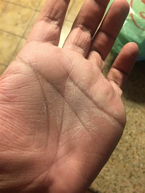 Am I dehydrated? : r/peeling