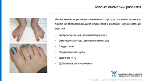 Пролапс митрального клапана. Диагностика и лечение