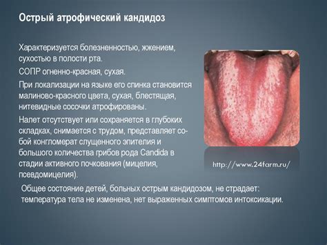 Кандидоз слизистой оболочки полости рта - презентация онлайн