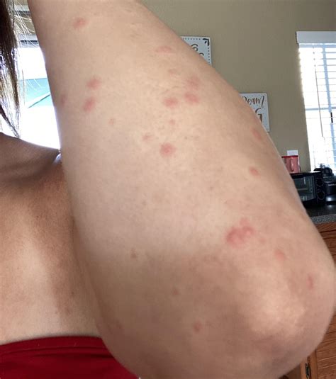 Carpet Beetle Skin Reaction