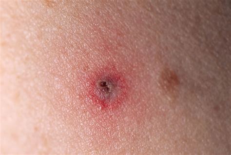 Lyme Disease Tick Bite Rash