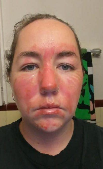 3rd Degree Burn Face