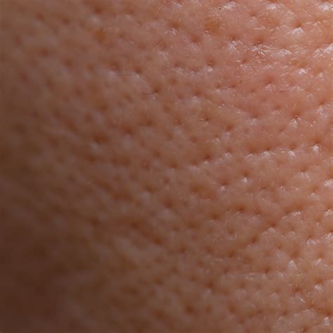 Large Pores: Causes and Effective Treatment Options - Dermedica Perth