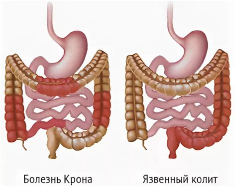 Воспалительные заболевания кишечника / Заболевания / Клиника ЭКСПЕРТ