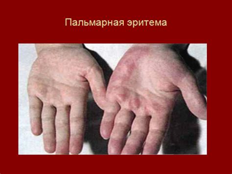 Цирроз печени
