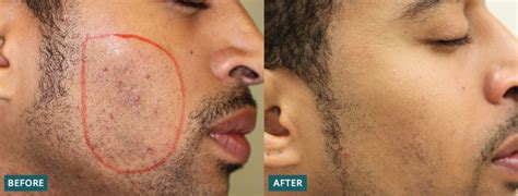 Ingrown Hairs | Dermatology & Laser Surgery Center