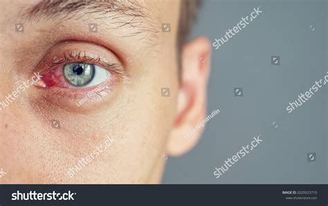 5,510 Red Eyelid Images, Stock Photos & Vectors | Shutterstock