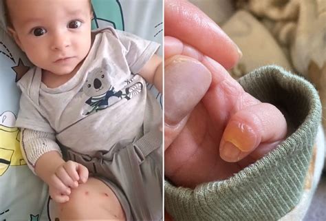 Bolha No Dedo De Bebe - Bolhas no corpo de recém-nascido revelam doença sem cura, em SP: “Meu ...