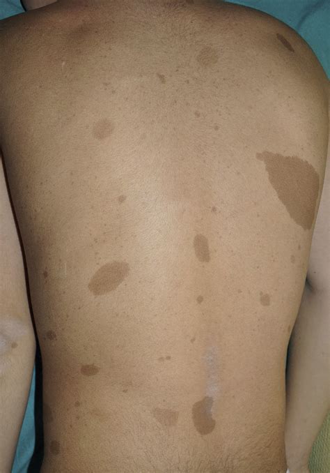 Toda Mancha Café Com Leite E Neurofibromatose - Neurofibromatosis tipo 1: más que manchas café con leche, efélides y ...