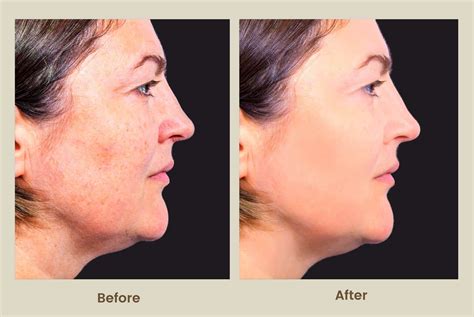 BioRevitalization Peel PRX-T33 Newport Beach | PCH MedSpa