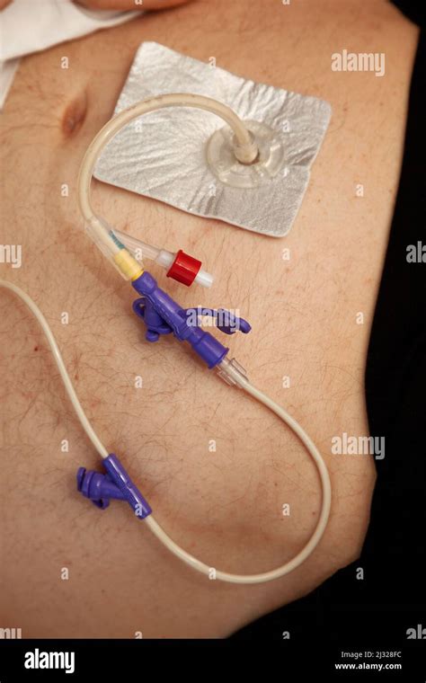 Peg tube hi-res stock photography and images - Alamy