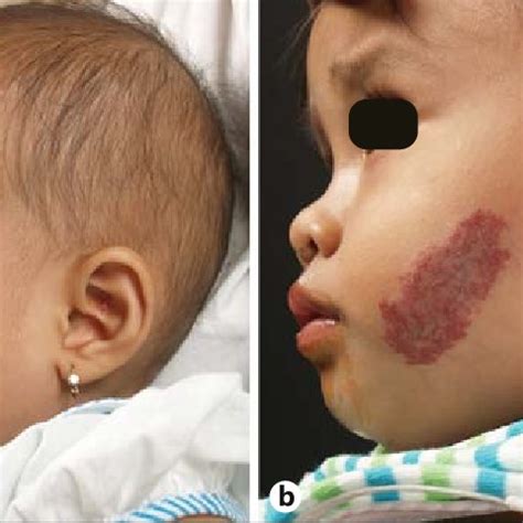Patient with superficial IH before ( a ) and after treatment ( b ) with ...