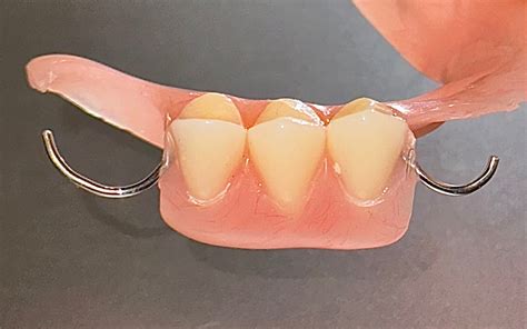 Acrylic Partial Denture, Flipper – The Clear Guard