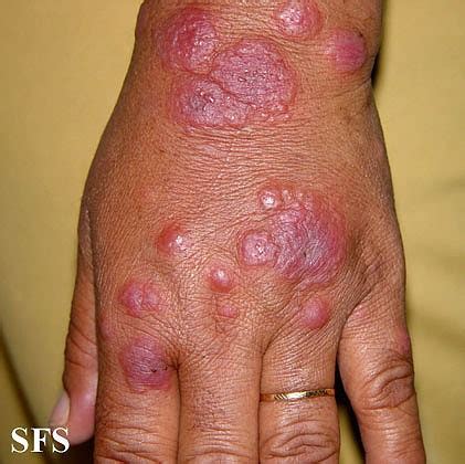 Erythema Multiforme Minor
